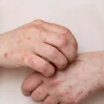 Querétaro registra 19 casos de sarampión